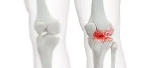 Arthrose Knie