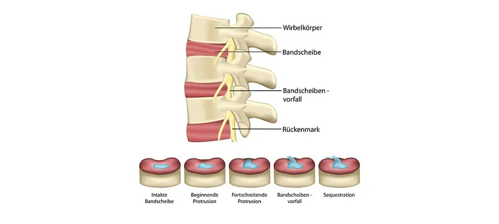 Bandscheibenprotrusion