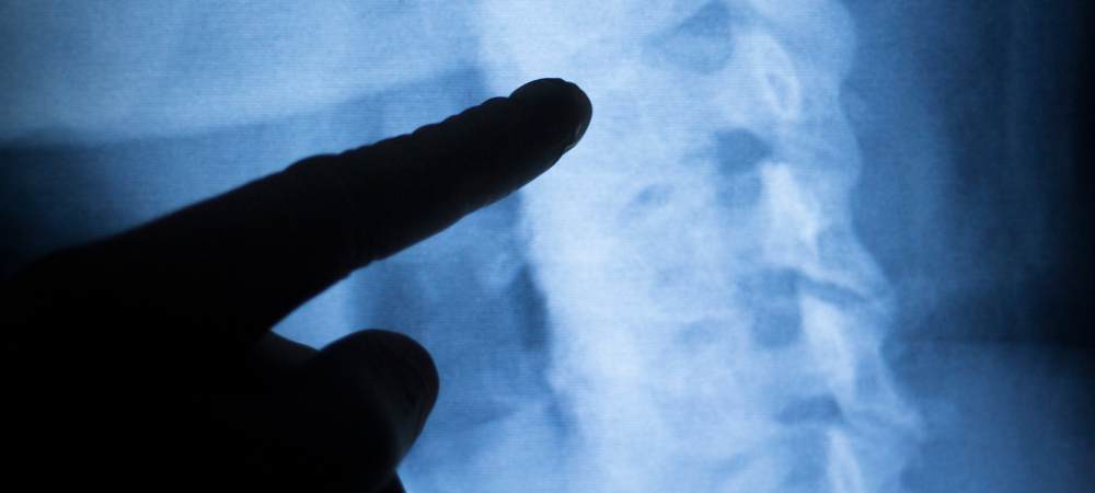 Hand in Handschuh deutet auf Röntgenbilde der Wirbelsäule