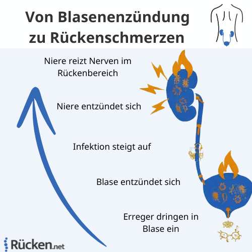 Schaubild: Von Blasenentzündung zu Rückenschmerzen