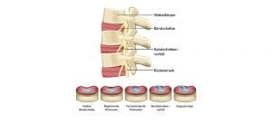 Bandscheibenprotrusion Bandscheibenprotrusion